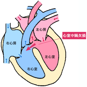 心室中隔欠損症の心内短絡