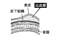 産瘤の出血部