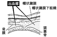 頭血腫の出血部