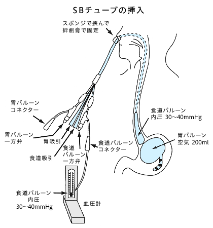 SBチューブの挿入