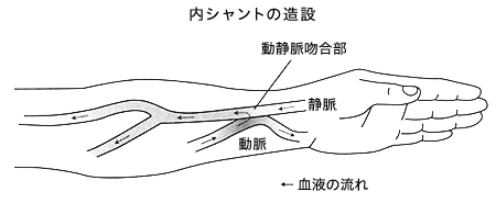 血液透析の内シャント