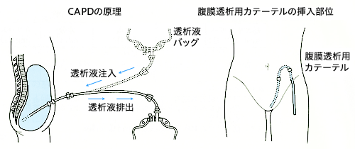 CAPDの原理、カテーテル挿入部位
