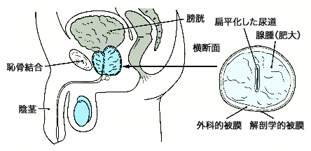 前立腺肥大症