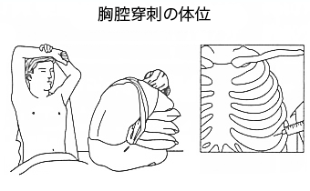 胸腔穿刺の体位