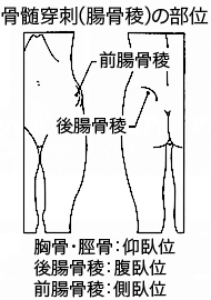 骨髄穿刺（腸骨稜）