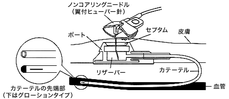 栄養剤の注入方法