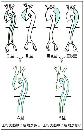 解離性大動脈瘤の分類