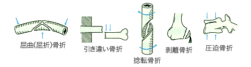 骨折の分類