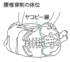 腰椎穿刺の体位