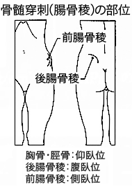 骨髄穿刺（腸骨稜）