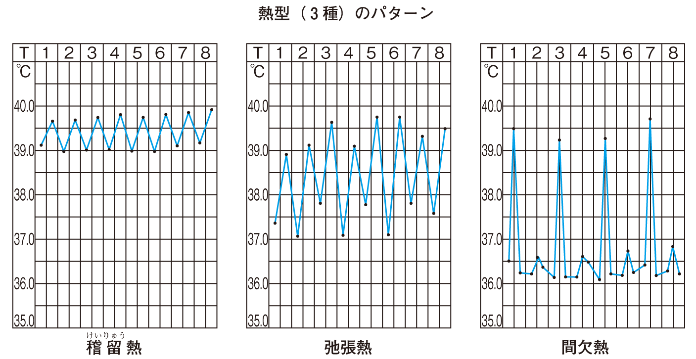 熱型（3種）のパターン