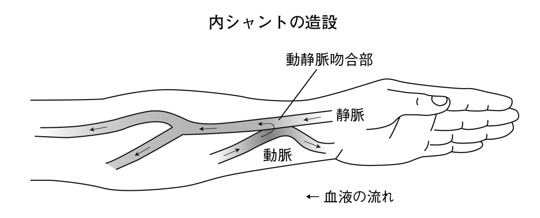 内シャントンの造設