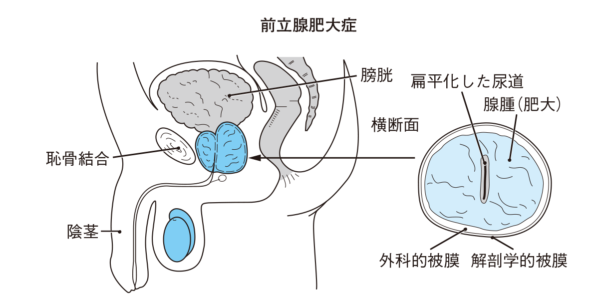 前立腺肥大症